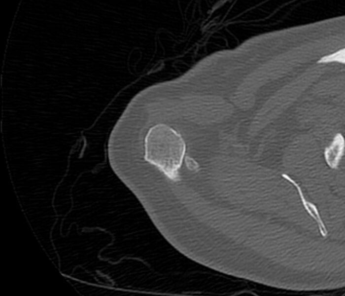 File:Avulsion fracture - greater tuberosity of humerus (Radiopaedia 71216-81514 Axial bone window 13).jpg