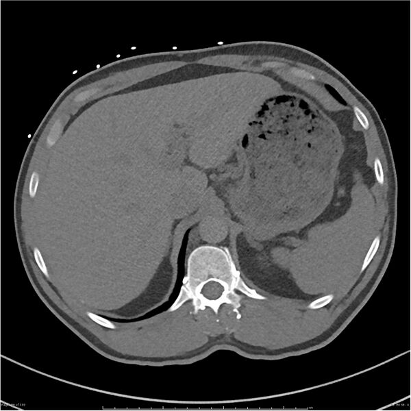 File:Azygos venous system anatomy (CT pulmonary angiography) (Radiopaedia 25928-26077 Axial C+ CTPA 86).jpg