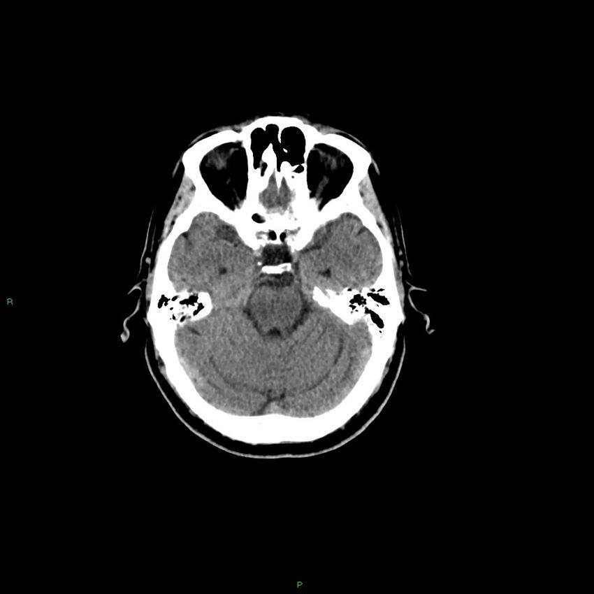 Basal ganglia hemorrhage (Radiopaedia 58346-65467 Axial non-contrast 40).jpg