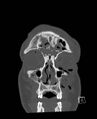 Base of skull fracture with bilateral Le Fort fractures (Radiopaedia 47094-51638 Coronal bone window 84).jpg