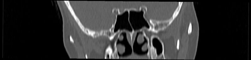 File:Basilar impression (Radiopaedia 52411-58522 Coronal bone window 4).jpg