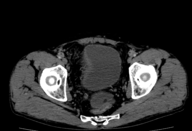 File:Behçet's disease. abdominal vasculitis (Radiopaedia 55955-62570 Axial 60).jpg