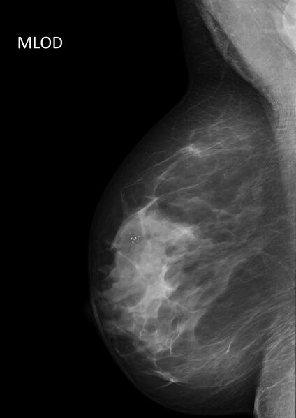 File:Benign breast clustered microcalcifications (Radiopaedia 84548-99945 MLO 1).jpg
