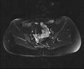 Bicornuate bicollis uterus (Radiopaedia 61626-69616 Axial PD fat sat 13).jpg