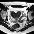 Bicornuate uterus (Radiopaedia 11104-11492 Axial T2 21).jpg