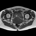 Bicornuate uterus (Radiopaedia 61974-70046 Axial T1 33).jpg