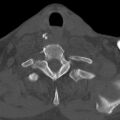 Bilateral C6-7 locked facet dislocation (Radiopaedia 28506-28748 Axial bone window 32).jpeg