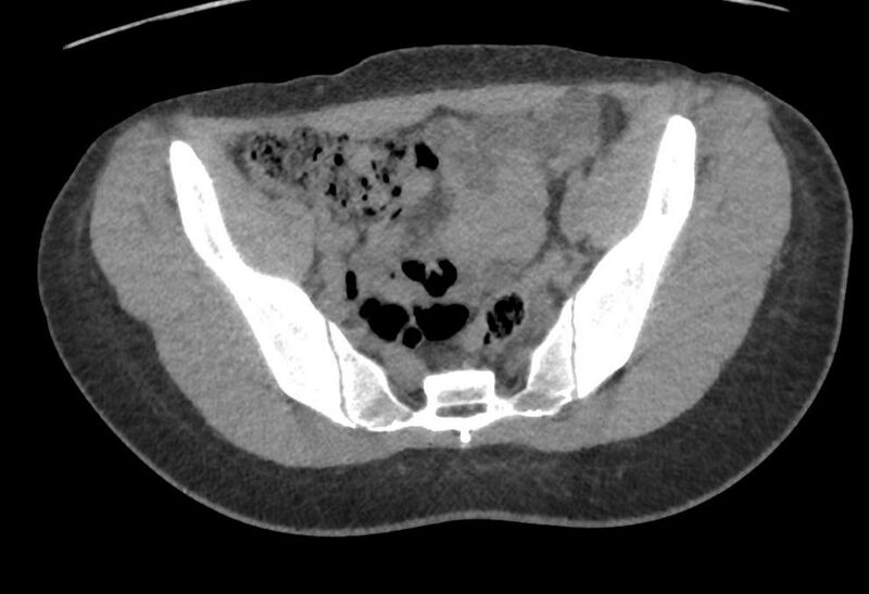 File:Bilateral mature cystic ovarian teratoma (Radiopaedia 88821-105592 Axial non-contrast 1).jpg