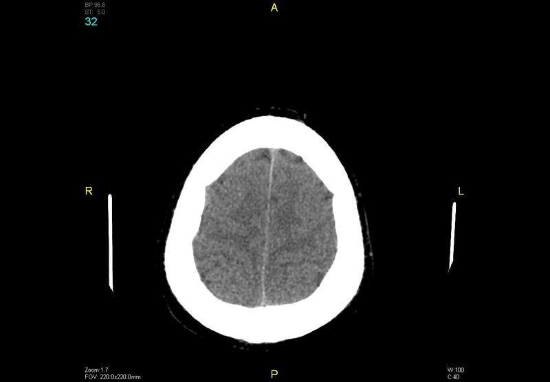 File:Bilateral medial medullary infarction (Radiopaedia 42220-45295 Axial non-contrast 32).jpg