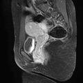 Bilateral ovarian endometriomas (Radiopaedia 87085-103347 F 15).jpg