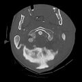 Bilateral perched facets with cord injury (Radiopaedia 45587-49713 Axial bone window 24).jpg