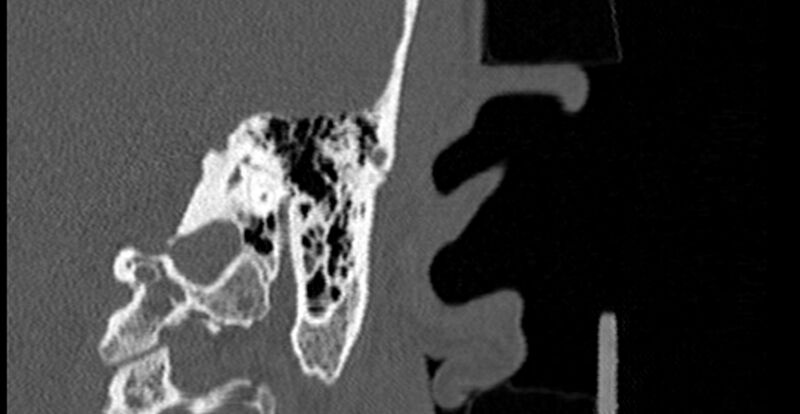 File:Bilateral temporal bone fractures (Radiopaedia 29482-29970 B 61).jpg