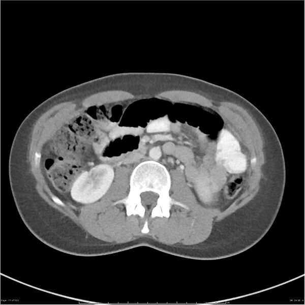 File:Bilateral ureteritis and cystitis (Radiopaedia 25340-25594 A 34).jpg