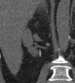 Bile leak from accessory duct(s) of Luschka post cholecystectomy (Radiopaedia 40736-43389 B 48).jpg