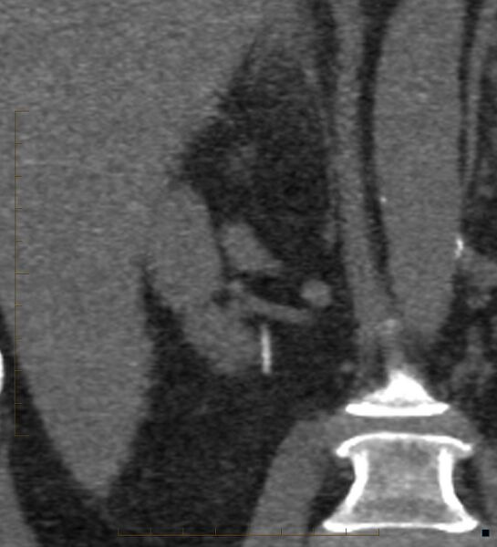 File:Bile leak from accessory duct(s) of Luschka post cholecystectomy (Radiopaedia 40736-43389 B 48).jpg