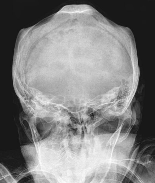 File:Biparietal osteodystrophy (Radiopaedia 46109-50461 Towne 1).jpg