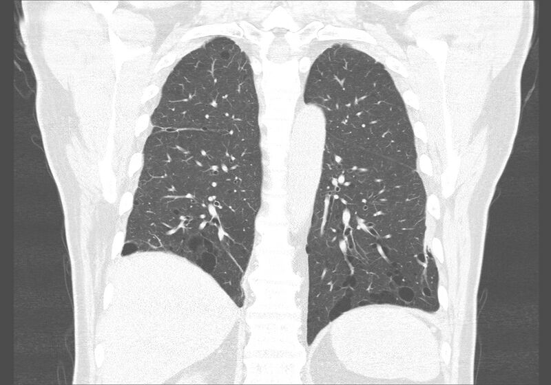 File:Birt-Hogg-Dubé syndrome (Radiopaedia 52578-58491 Coronal lung window 44).jpg