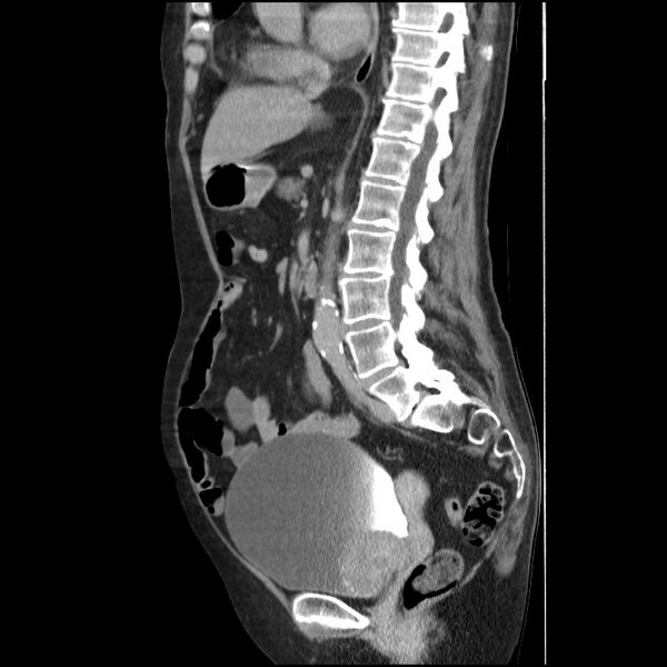 File:Bladder tumor detected on trauma CT (Radiopaedia 51809-57609 E 35).jpg