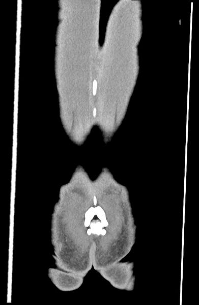 File:Blunt injury to the small bowel (Radiopaedia 74953-85987 B 93).jpg
