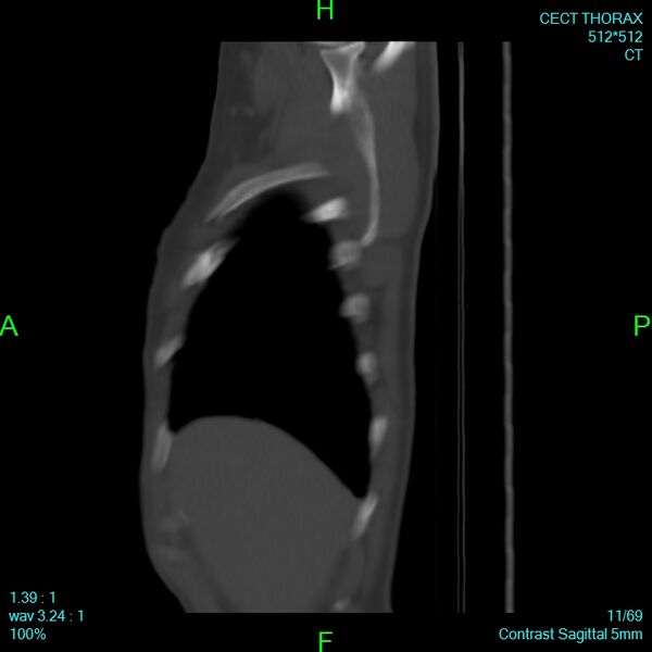File:Bone metastases from lung carcinoma (Radiopaedia 54703-60937 Sagittal bone window 11).jpg