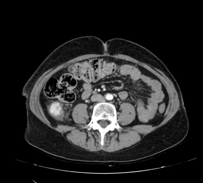 File:Bosniak renal cyst - type IV (Radiopaedia 22929-22953 B 65).jpg
