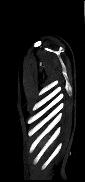 File:Brachiocephalic trunk pseudoaneurysm (Radiopaedia 70978-81191 C 89).jpg