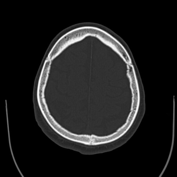 File:Brain Pantopaque remnants (Radiopaedia 78403-91048 Axial bone window 54).jpg