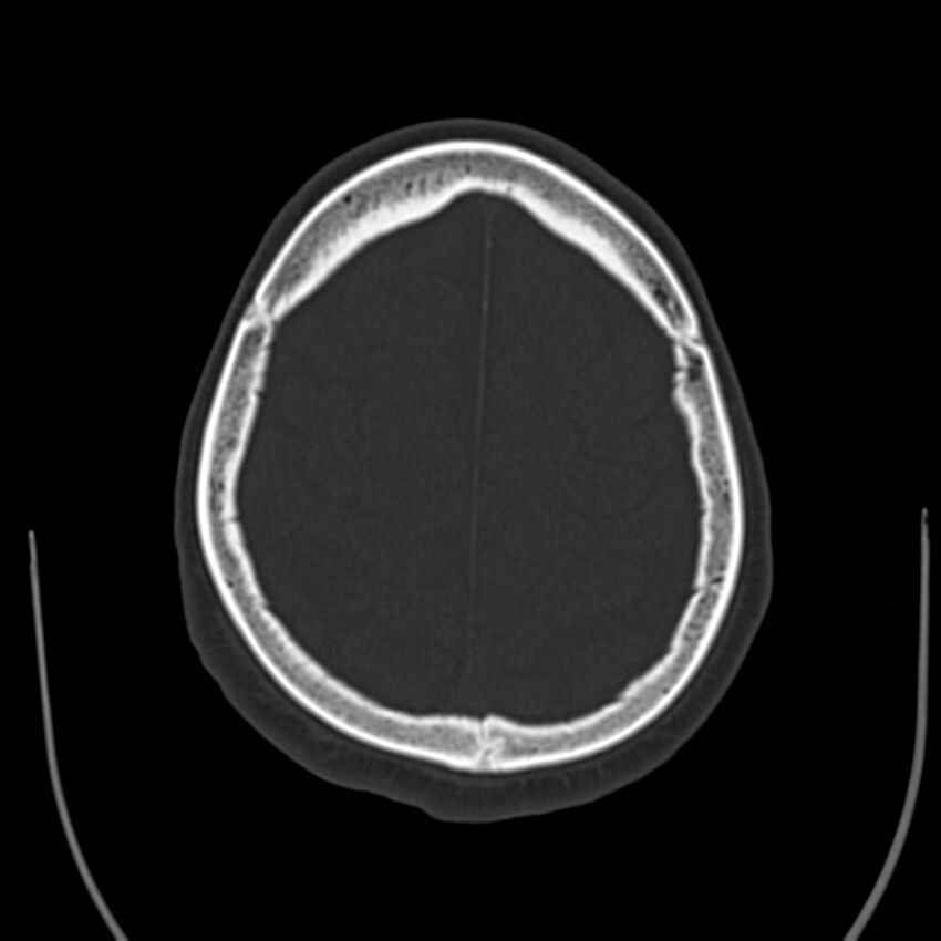 Brain Pantopaque remnants (Radiopaedia 78403-91048 Axial bone window 54).jpg