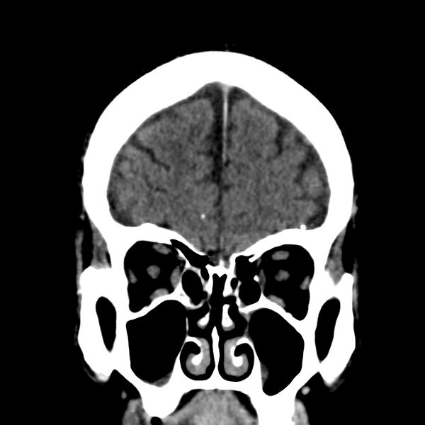 File:Brain Pantopaque remnants (Radiopaedia 78403-91048 Coronal non-contrast 16).jpg