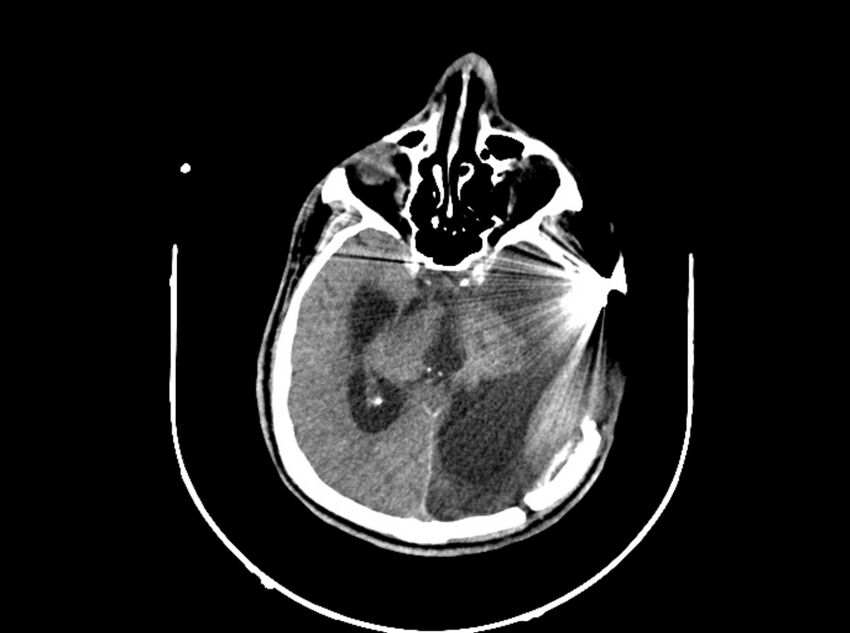 Brain injury by firearm projectile (Radiopaedia 82068-96088 A 117).jpg