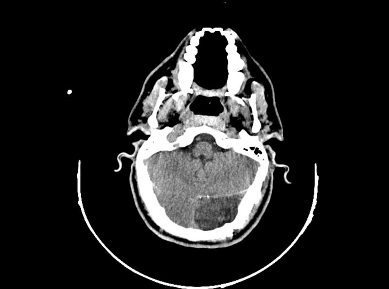 File:Brain injury by firearm projectile (Radiopaedia 82068-96088 A 76).jpg
