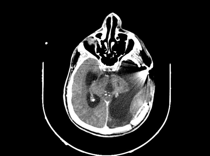 File:Brain injury by firearm projectile (Radiopaedia 82068-96088 B 116).jpg