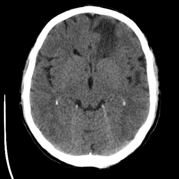 File:Brain metastases from lung cancer (Radiopaedia 24480-24781 Axial non-contrast 20).jpg