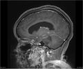 Brainstem glioma (Radiopaedia 21819-21775 D 26).jpg