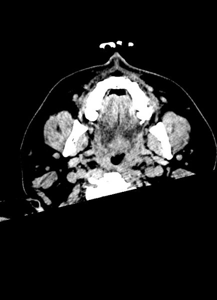 File:Brainstem hemorrhage (Radiopaedia 81294-94976 Axial non-contrast 74).jpg