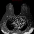 Breast carcinoma (multicentric multifocal in mammary Paget disease) (Radiopaedia 50966-56512 Axial T1 C+ fat sat 10).jpg