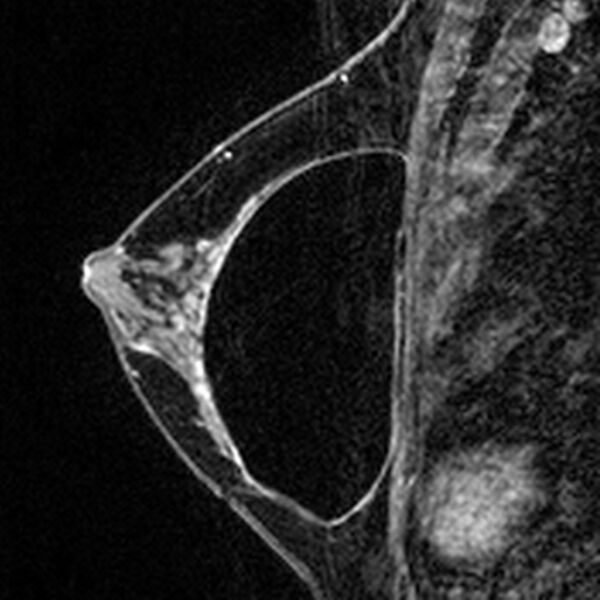 File:Breast implants - MRI (Radiopaedia 26864-27035 Sagittal T2 26).jpg