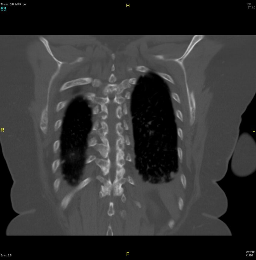 Breast primary with lung and bone metastases (Radiopaedia 40620-43228 bone window 63).jpg