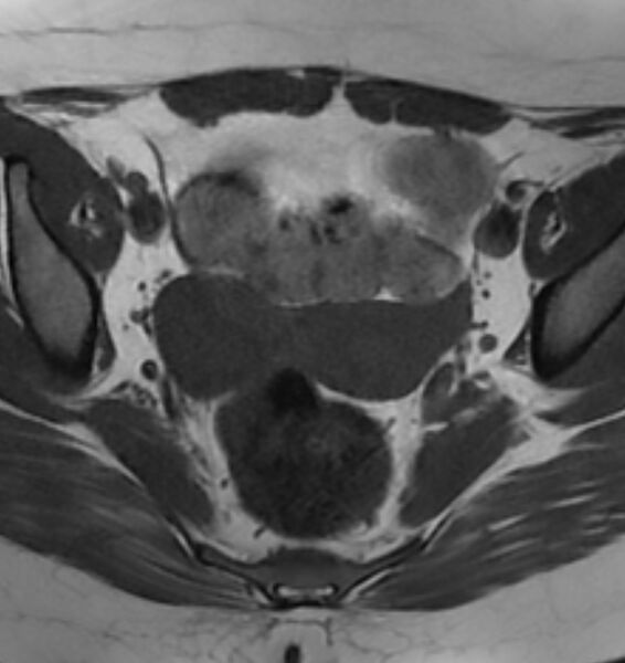 File:Broad ligament leiomyoma (Radiopaedia 81634-95516 Axial T1 12).jpg