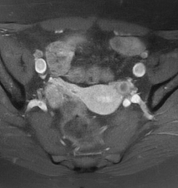 File:Broad ligament leiomyoma (Radiopaedia 81634-95516 Axial T1 C+ fat sat 10).jpg