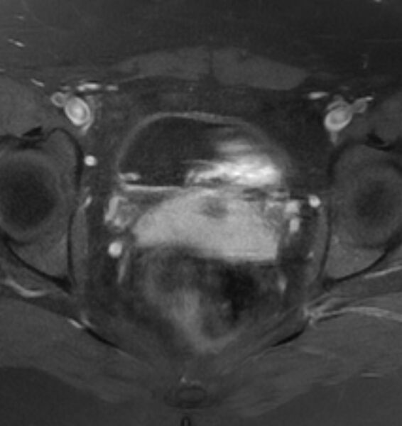 File:Broad ligament leiomyoma (Radiopaedia 81634-95516 Axial T1 C+ fat sat 17).jpg