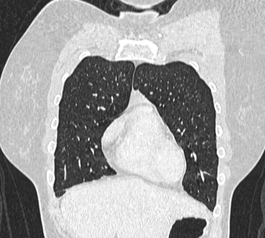 Bronchial atresia (Radiopaedia 50007-55297 Coronal lung window 16).jpg