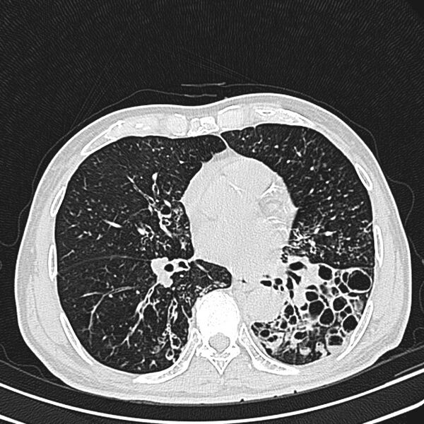 File:Bronchiectasis (Radiopaedia 22061-22059 lung window 18).jpg