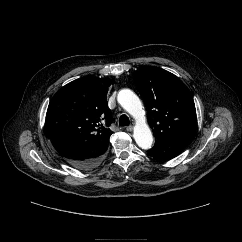 Bronchogenic adenocarcinoma and pulmonary embolism (Radiopaedia 9097-9806 D 23).jpg