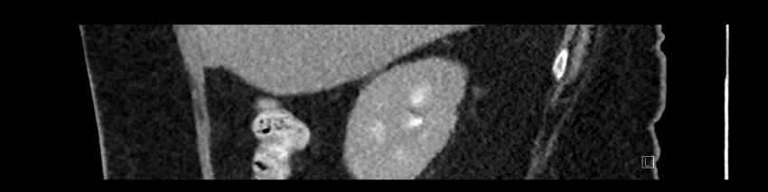 Buried bumper syndrome - gastrostomy tube (Radiopaedia 63843-72575 Sagittal Inject 97).jpg
