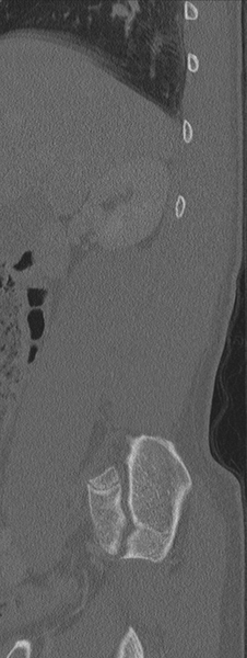 File:Burst fracture - T12 with conus compression (Radiopaedia 56825-63647 Sagittal bone window 76).png