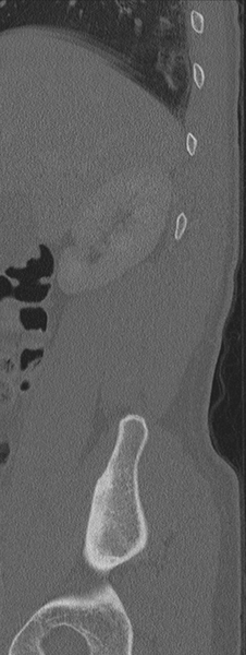 File:Burst fracture - T12 with conus compression (Radiopaedia 56825-63647 Sagittal bone window 83).png