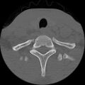 C5 facet fracture (Radiopaedia 58374-65499 Axial bone window 81).jpg