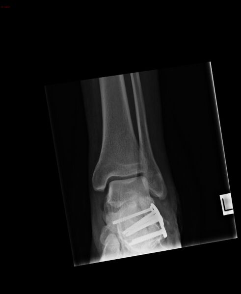 File:Calcaneal fracture and associated spinal injury (Radiopaedia 17896-17660 B 1).jpg