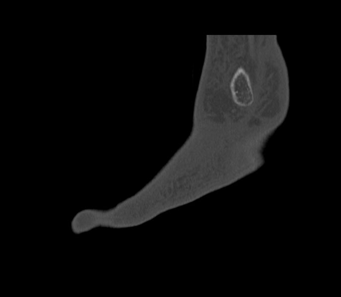 File:Calcaneal tuberosity avulsion fracture (Radiopaedia 22649-22668 Sagittal bone window 3).jpg